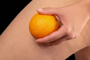 Pressoterapia e cellulite